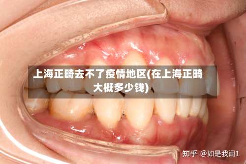 上海正畸去不了疫情地区(在上海正畸大概多少钱)-第3张图片